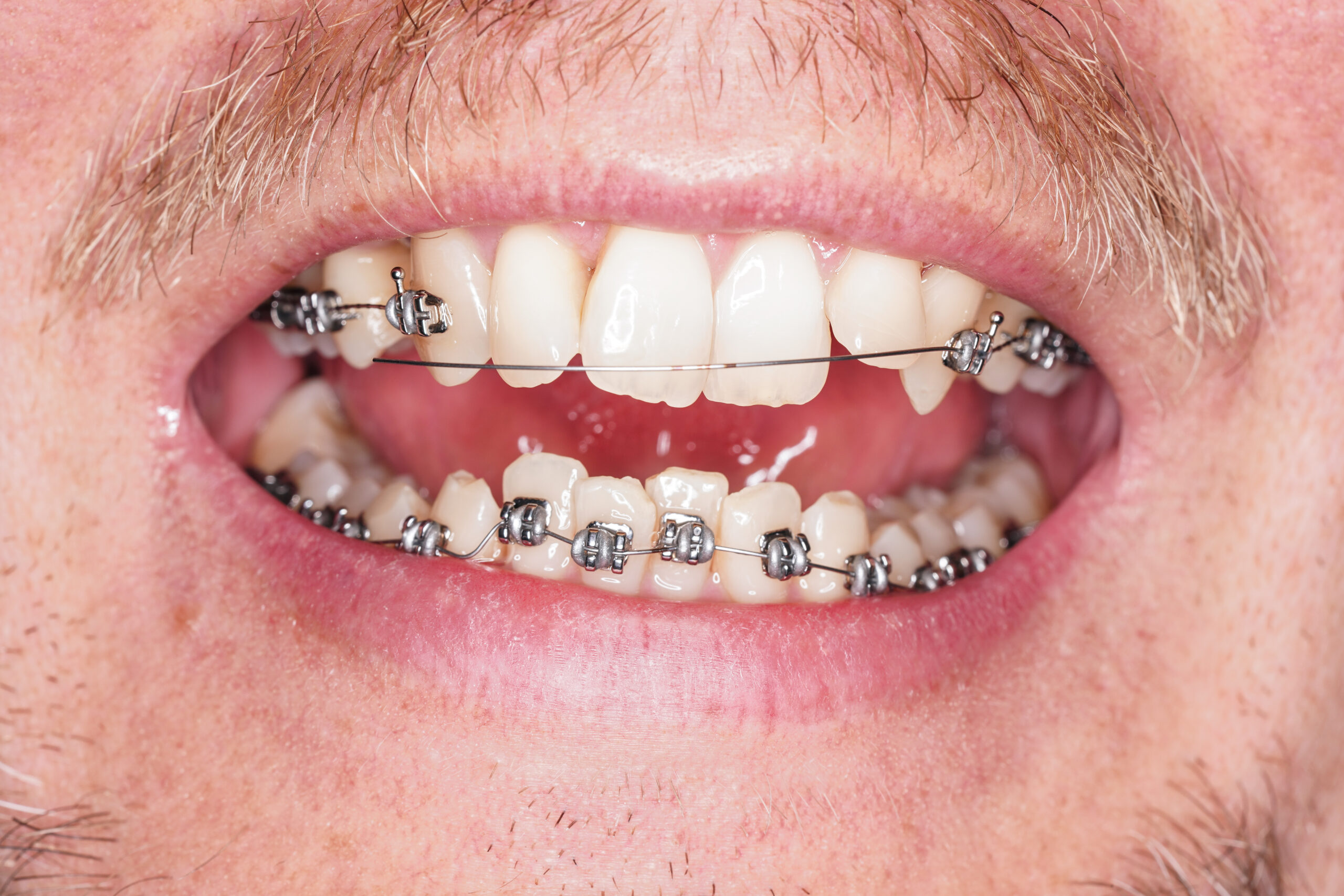 Man with dental braces, wire is damaged and loose, closeup detail to open mouth