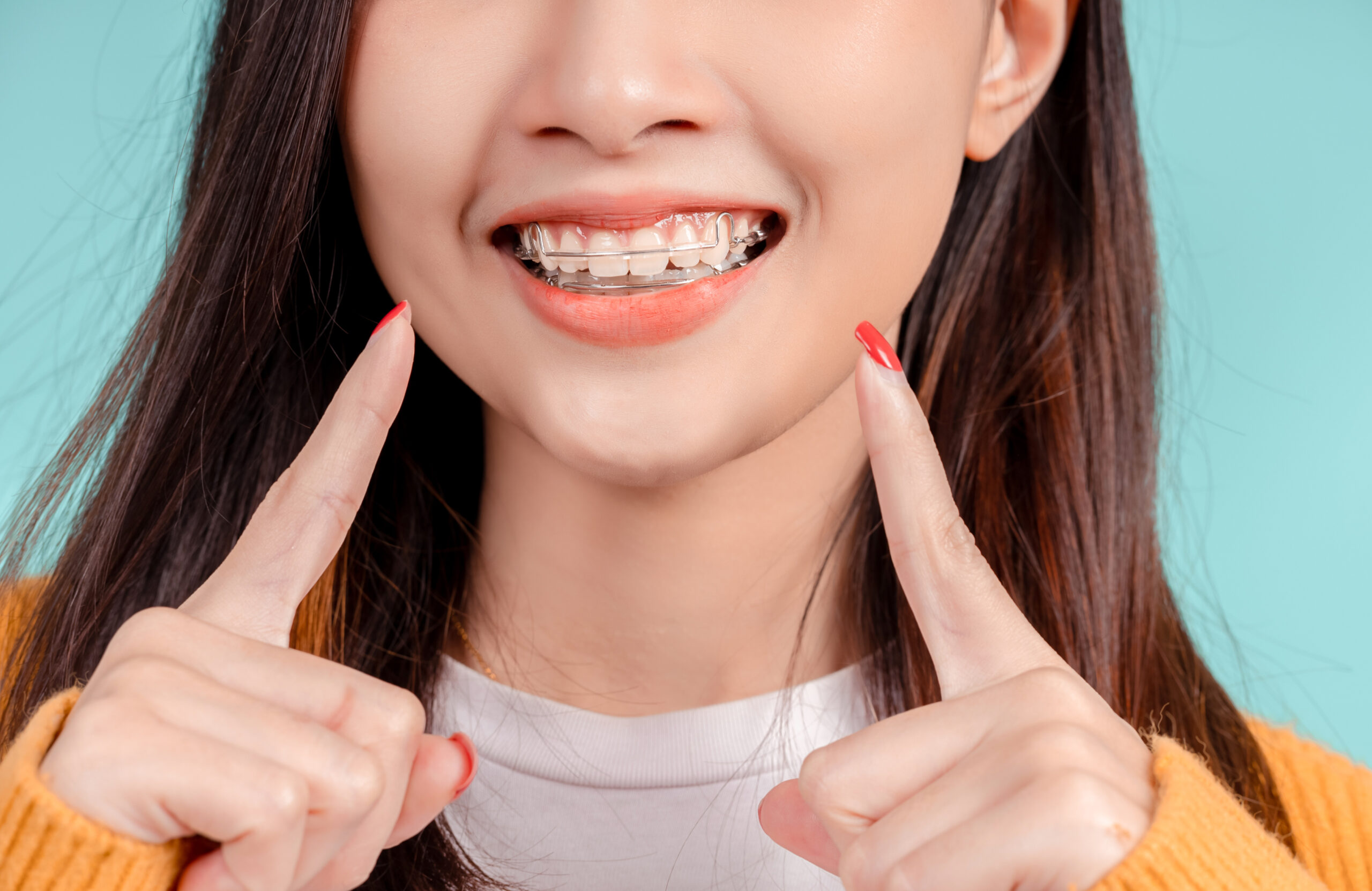 Dental Beautiful smiling of young asian woman with retainer braces glad emotion with white teeth increase confidence for healthy on blue background isolated, Happiness teenager facial expression.