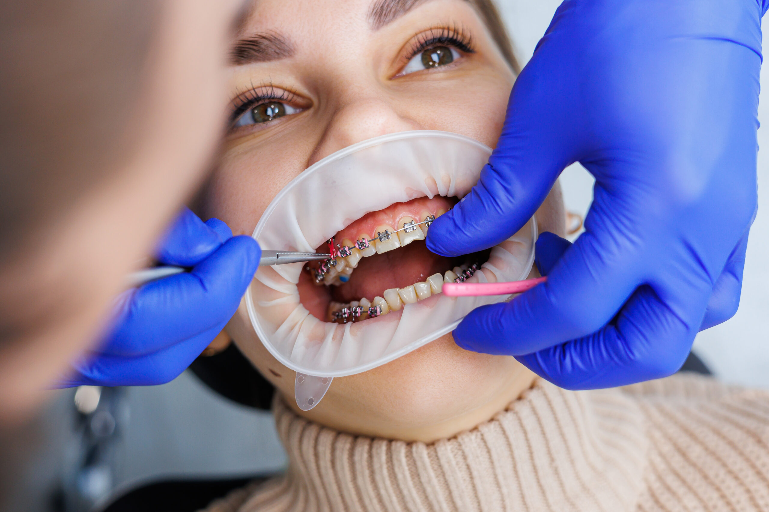 Woman teeth with braces on white teeth. An orthodontist uses dental instruments to place braces on a patient's teeth. The concept of dentistry, orthodontic treatment. Selective focus
