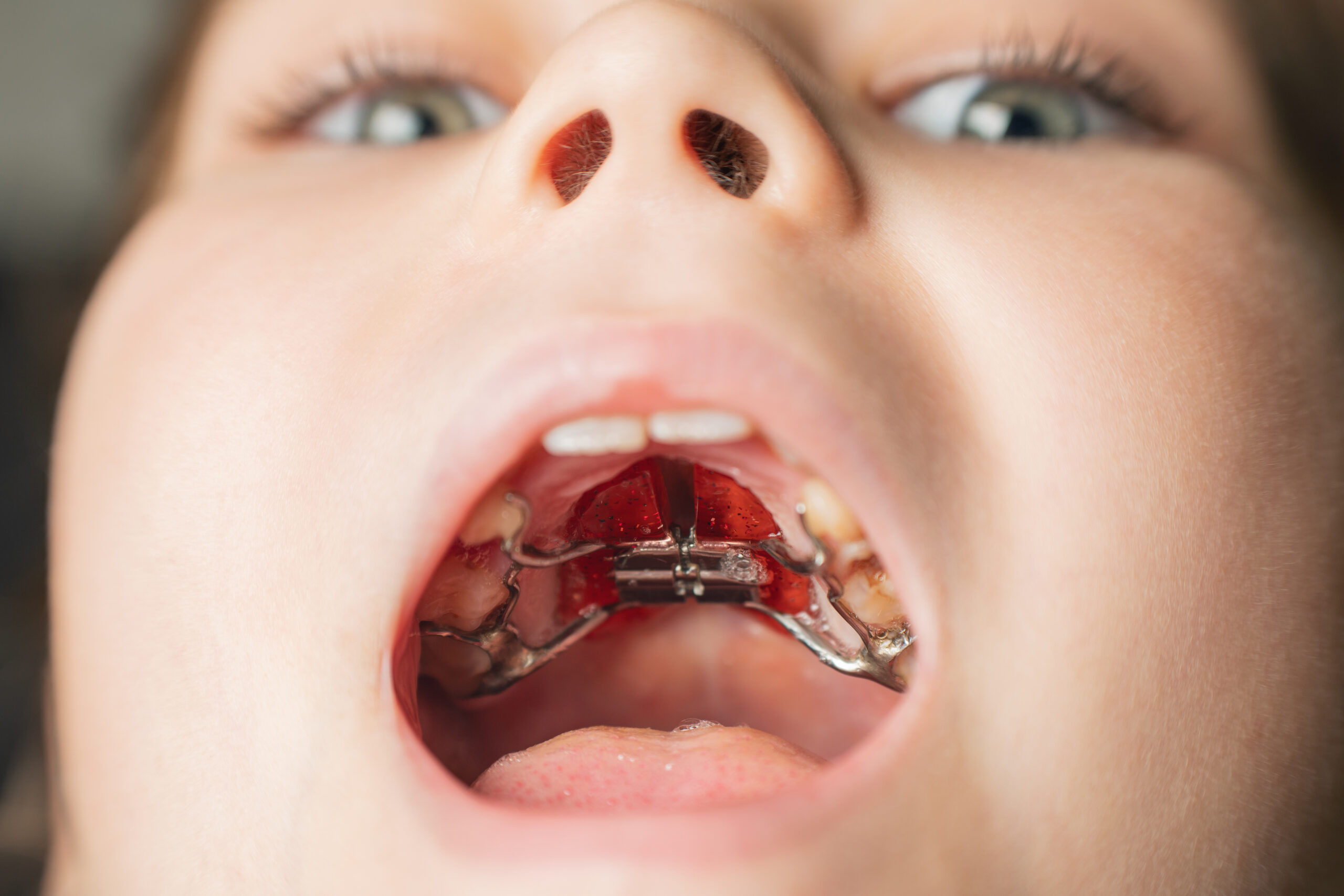 Palatal expander dental device in mouth. Medical and orthodontic equipment inside oral cavity.